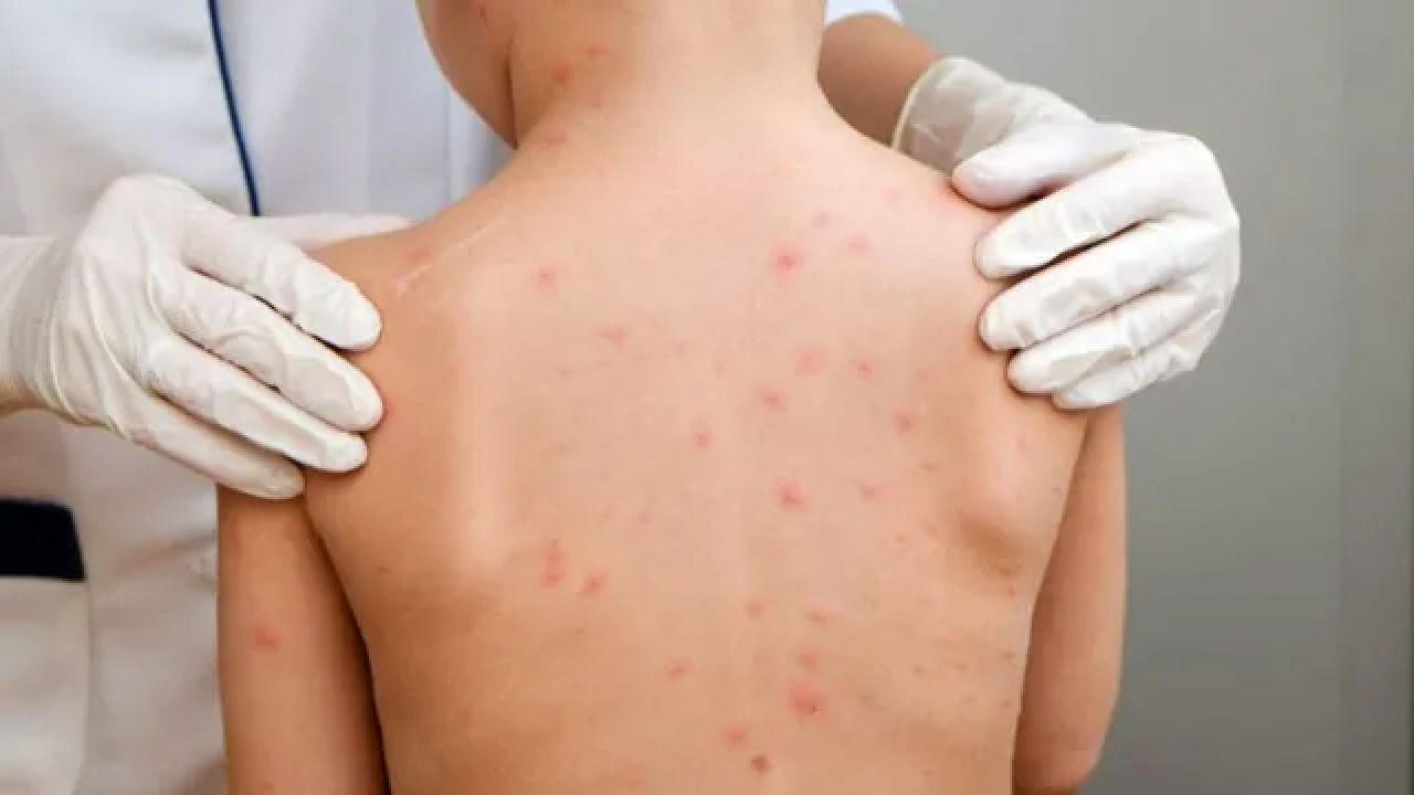 Caso de meningite viral é confirmado e dois suspeitos estão sob investigação em Corbélia